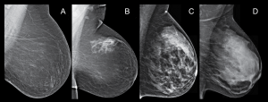 Resim: Mamografide farklı görünümler (http://densebreast-info.org/img/patients-faq_clip_image002.png adresinden alınmıştır)